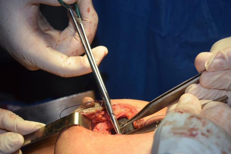 Comment réduire les cicatrices après une chirurgie mammaire ?