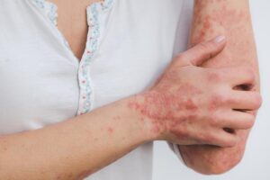 psoriasis visage