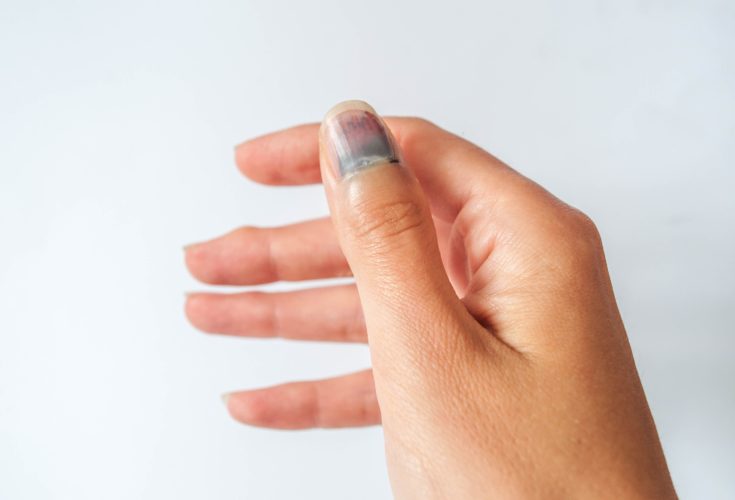 3 signes qui peuvent être à l’origine d’un ongle bleu