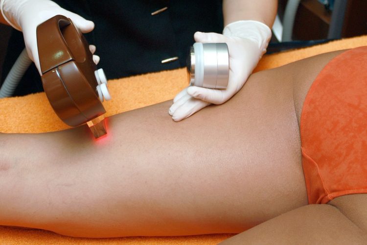 Épilation au laser