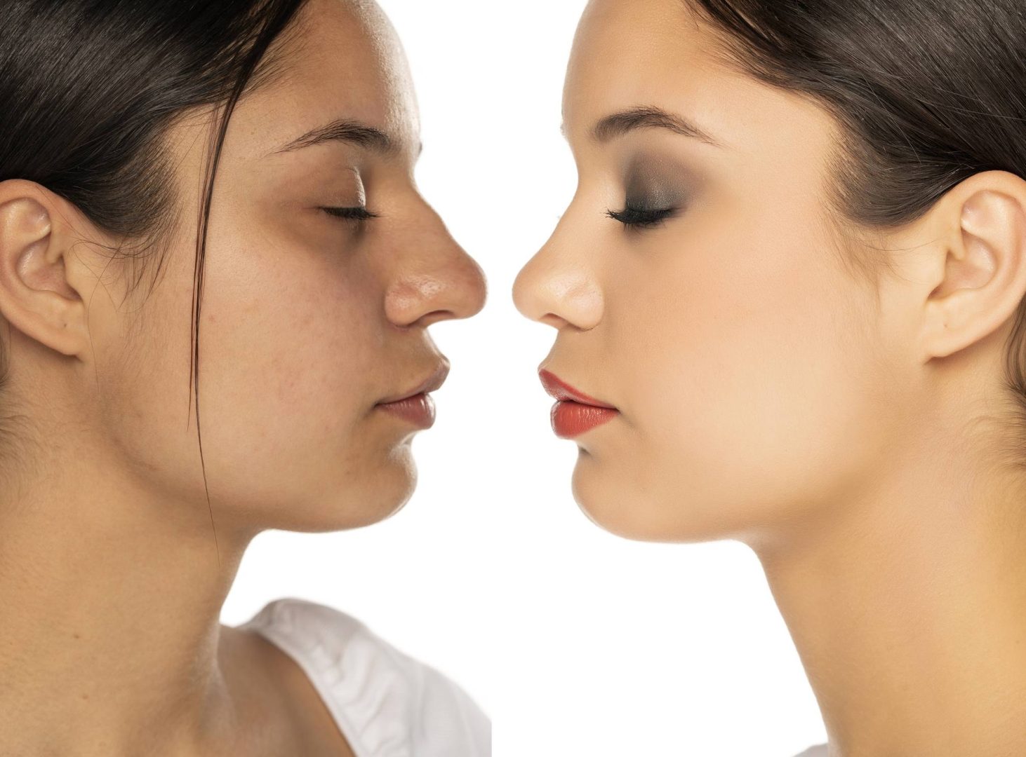 avant après rhinoplastie