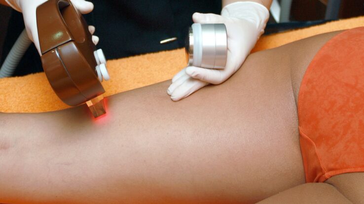 Épilation_laser_:_dites_adieu_aux_poils_indésirables_!